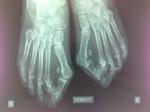 Hallux Valgus